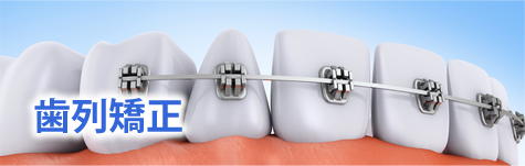 歯列矯正